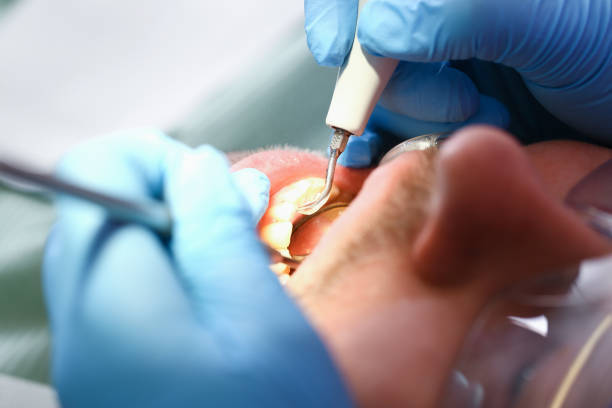 Best Emergency Treatment for Dental Infections or Abscesses in Fulton, IL
