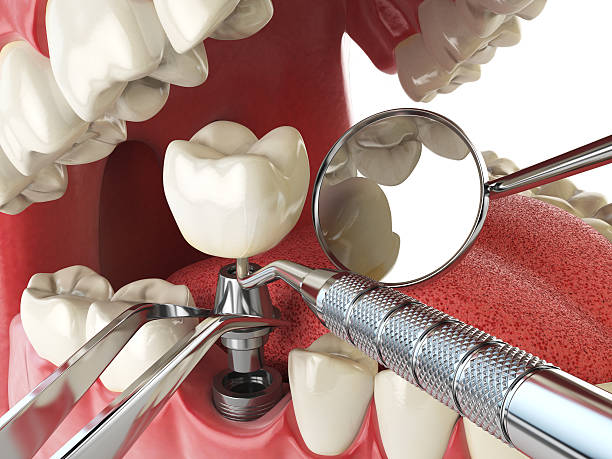 Best Emergency Treatment for Dental Infections or Abscesses in Fulton, IL