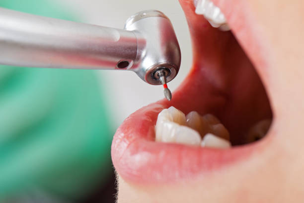 Best Emergency Tooth Extraction in Fulton, IL